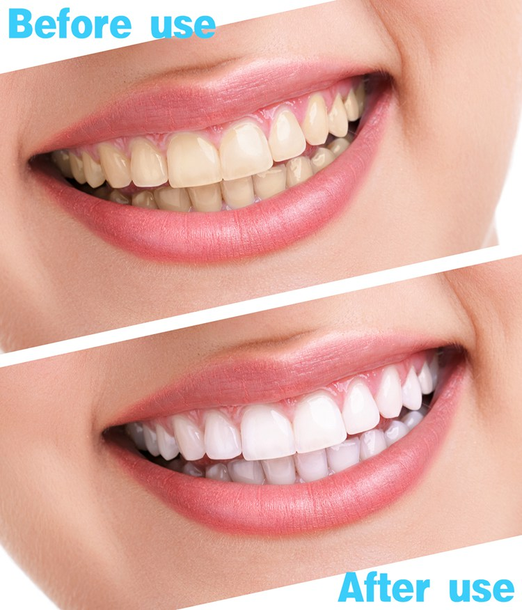 Teeth Whitening Strips Kit 5D  (14 Packs, 28 Pieces)
