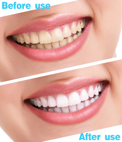 Teeth Whitening Strips Kit 5D  (14 Packs, 28 Pieces)